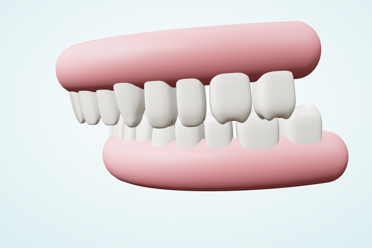 Temsili 3D çizim: alt çenenin geride konumlandığı kapanış